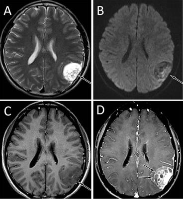 Case report: Primary intracranial EWs/PNET in adults: Clinical experience and literature review